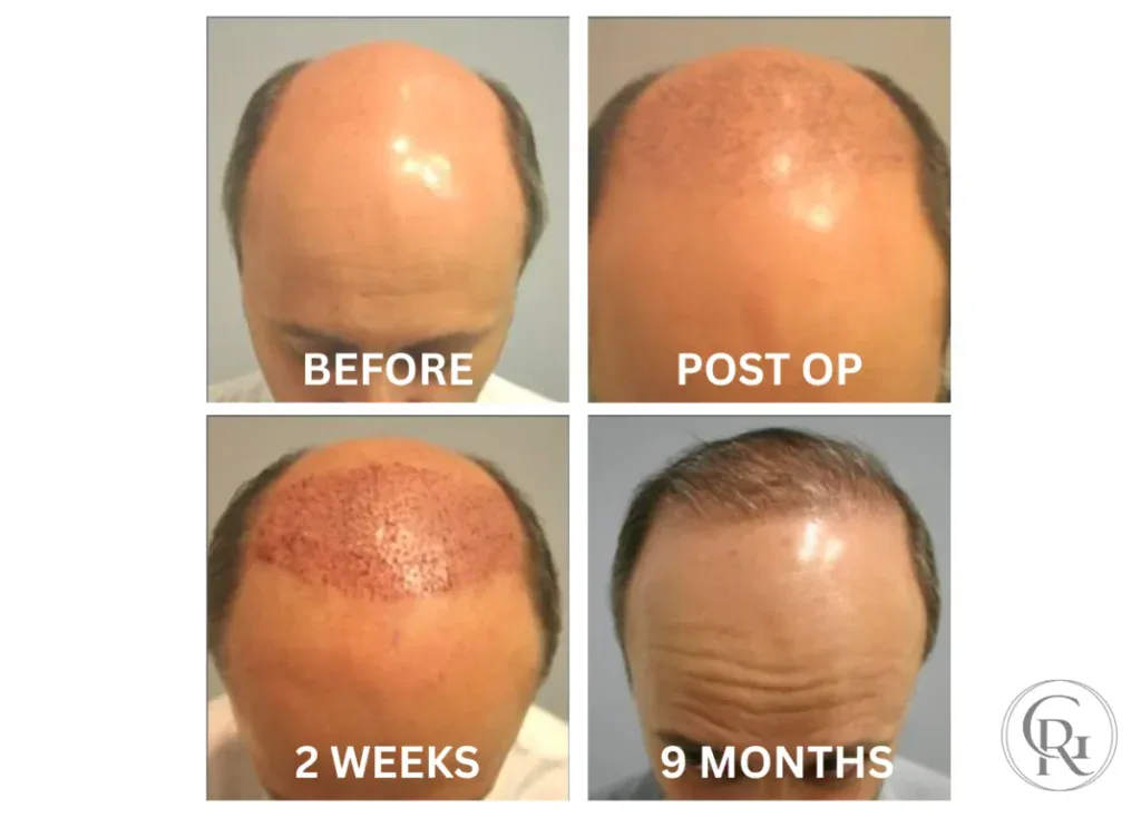 Robust hair restoration with FUE procedure at ROG Hair Institute.