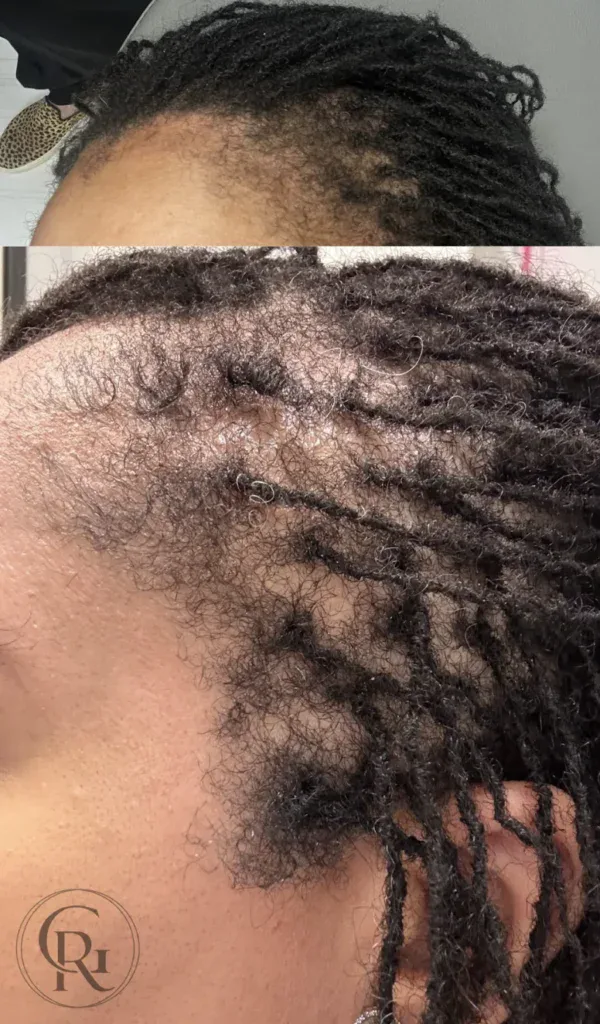 Healthy hair growth after Keravive scalp therapy treatment.