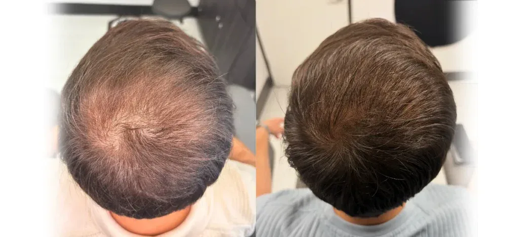 Thinning hair transformation before and after regenerative therapy at ROG Hair Institute.